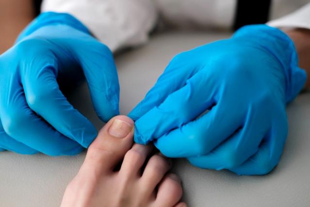 Ongle déformé